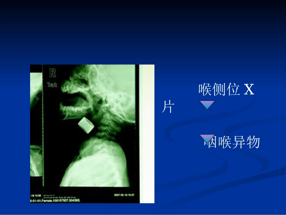 呼吸困难(喉源性)的处理技术及相关知识_第14页