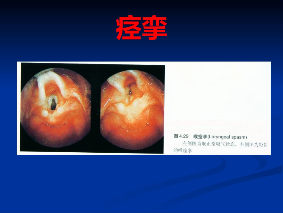 呼吸困难(喉源性)的处理技术及相关知识_第15页