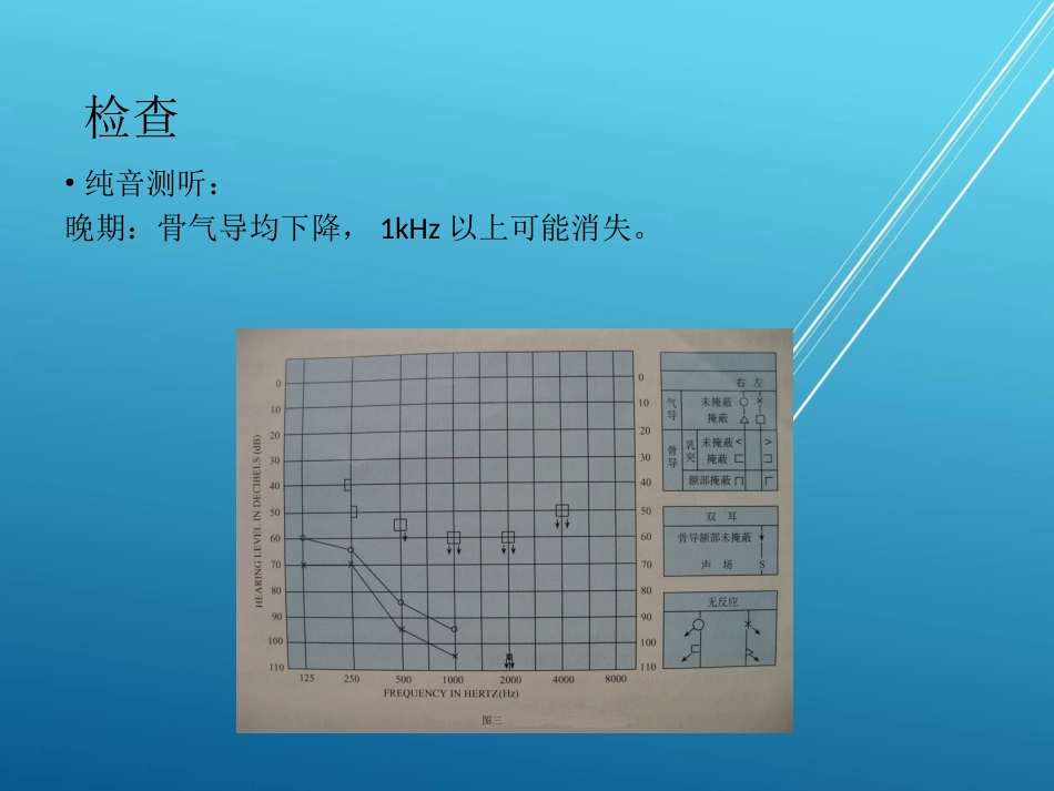 耳硬化症——_第10页