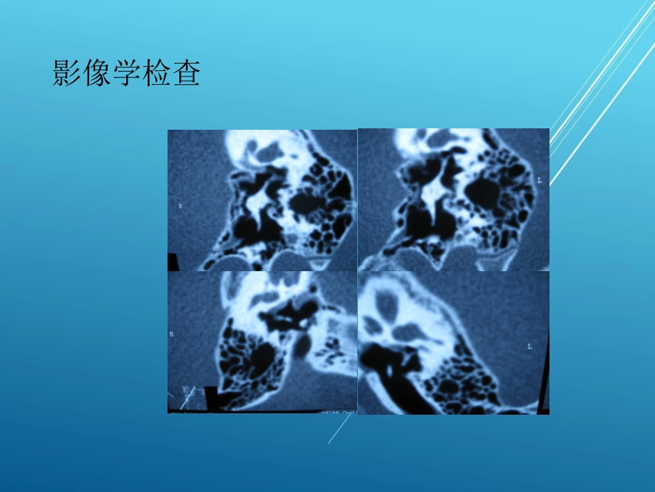 耳硬化症——_第11页