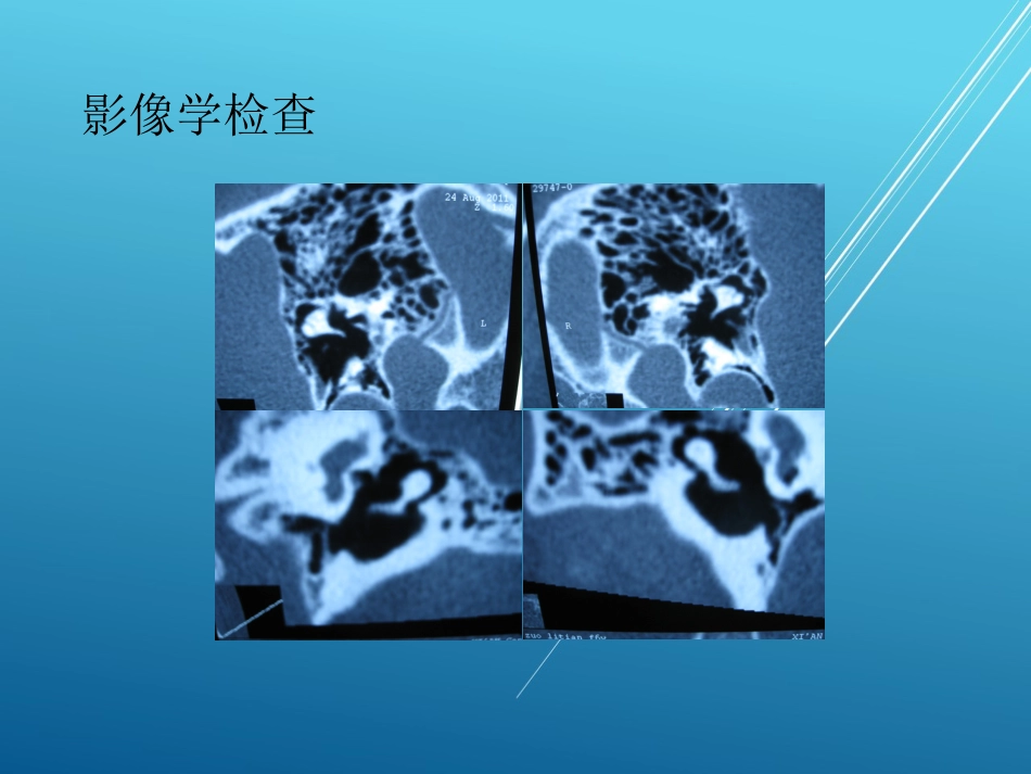 耳硬化症——_第12页