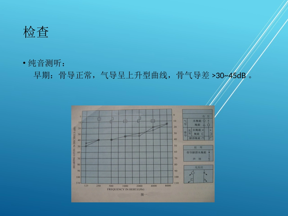 耳硬化症——_第8页
