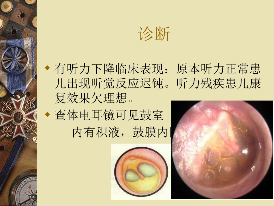 儿童中耳炎资料_第10页