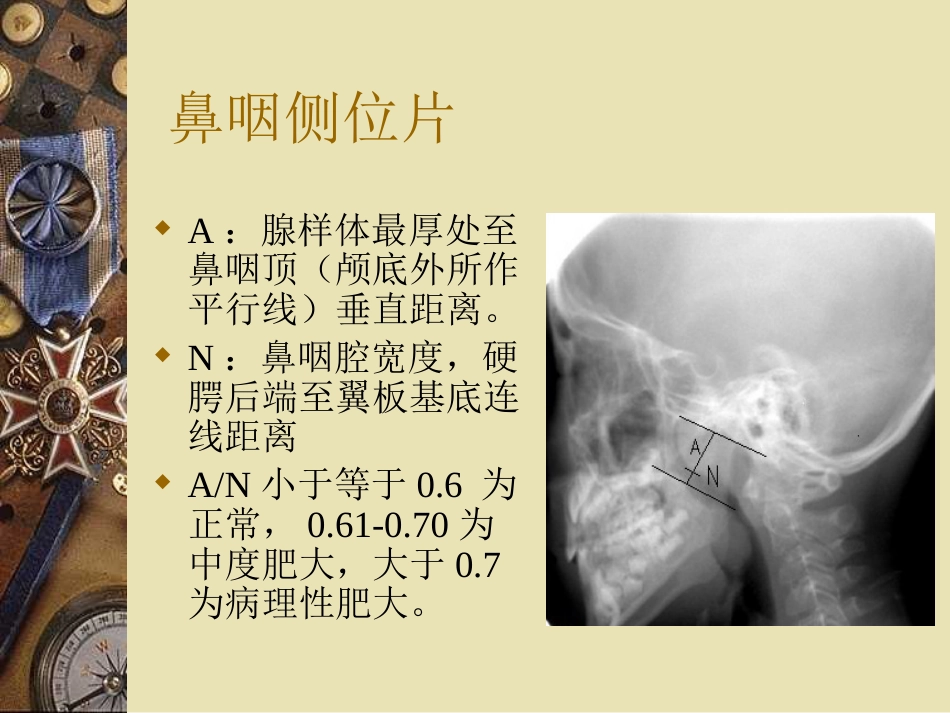儿童中耳炎资料_第12页