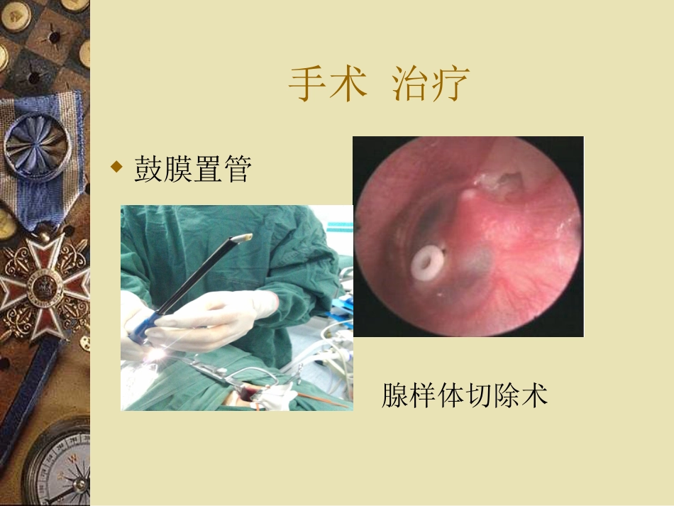 儿童中耳炎资料_第14页