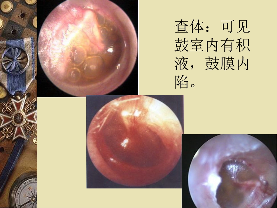 儿童中耳炎资料_第6页