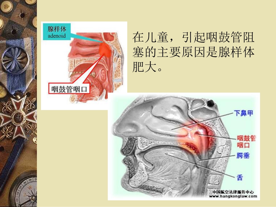 儿童中耳炎资料_第8页