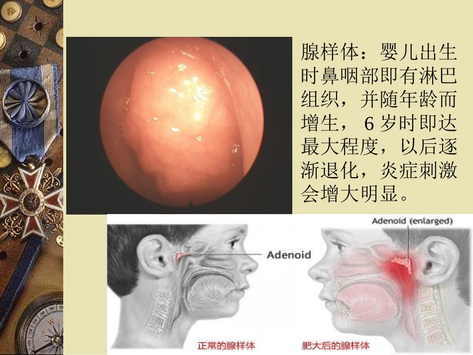 儿童中耳炎资料_第9页
