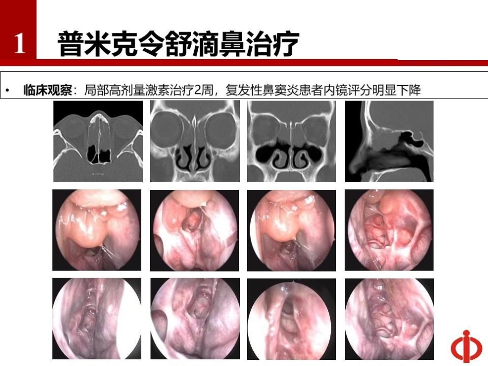 短期布地奈德混悬液滴鼻治疗慢性鼻窦炎伴鼻息肉的疗效_第9页