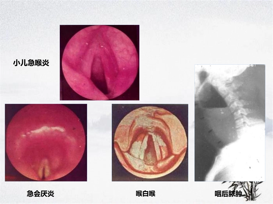 耳鼻咽喉头颈外科学——喉阻塞_第10页