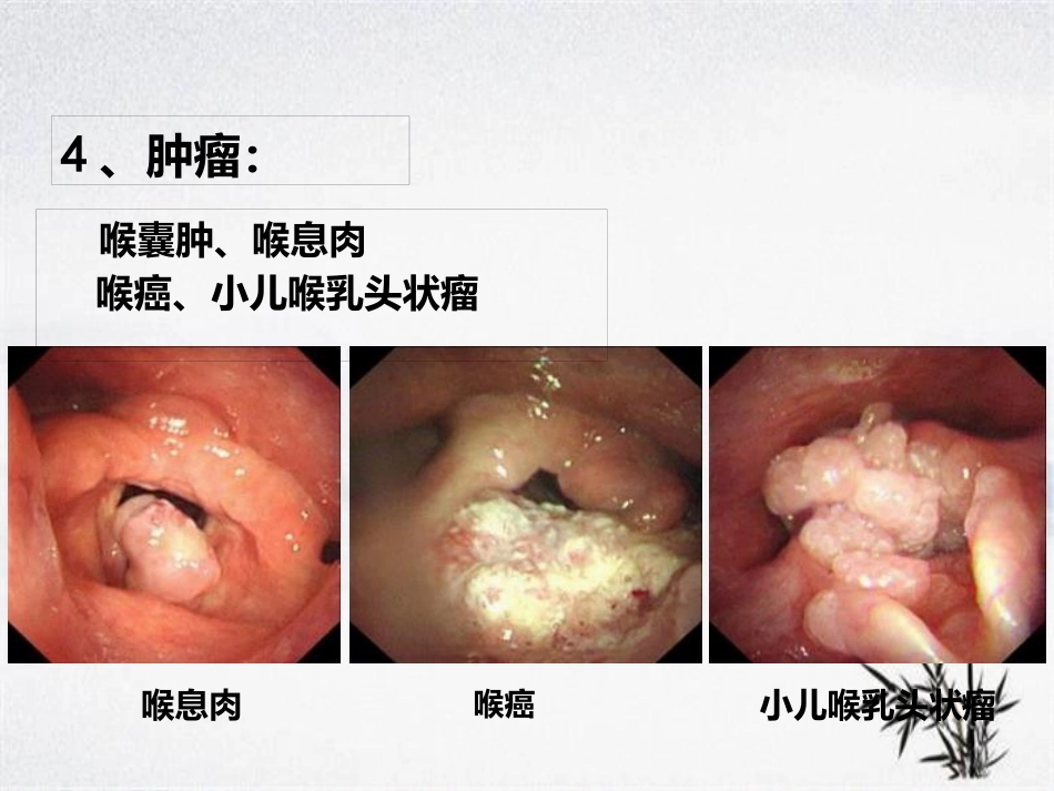 耳鼻咽喉头颈外科学——喉阻塞_第14页