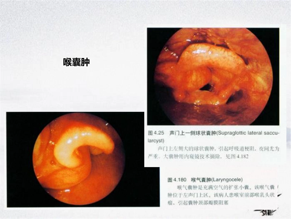 耳鼻咽喉头颈外科学——喉阻塞_第15页