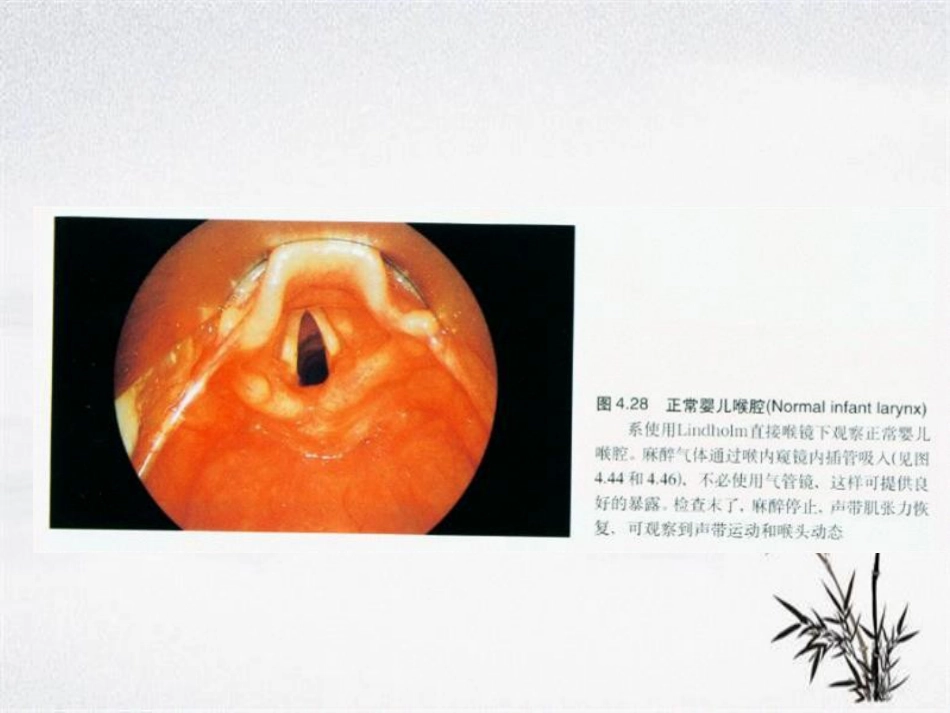 耳鼻咽喉头颈外科学——喉阻塞_第6页