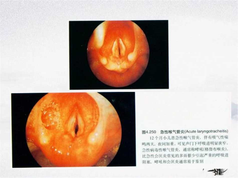 耳鼻咽喉头颈外科学——喉阻塞_第9页