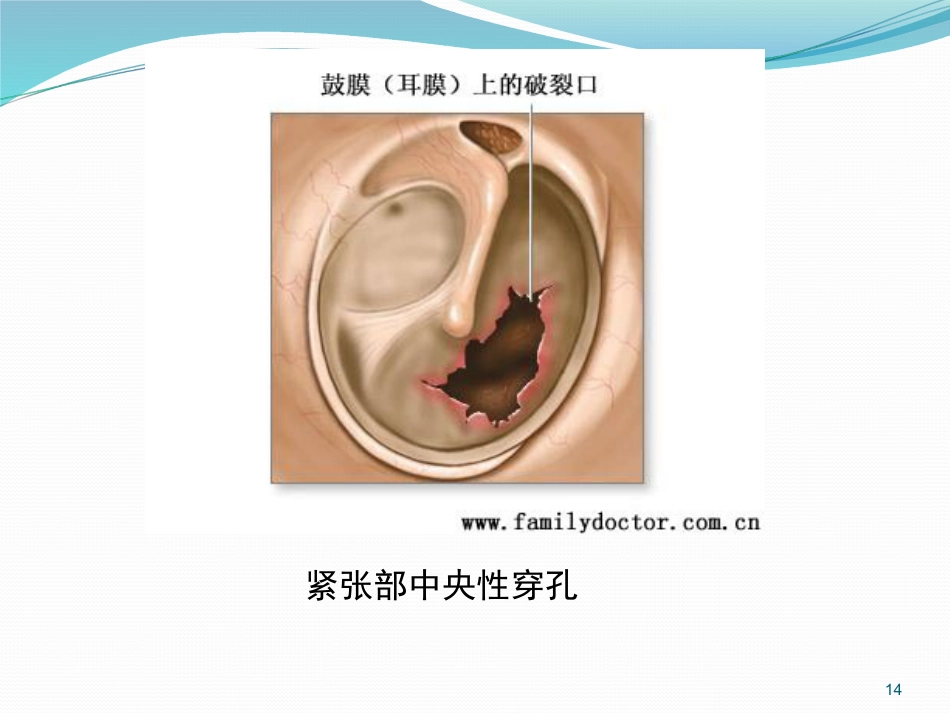 耳鼻喉的解剖及常见病PPT幻灯片_第14页