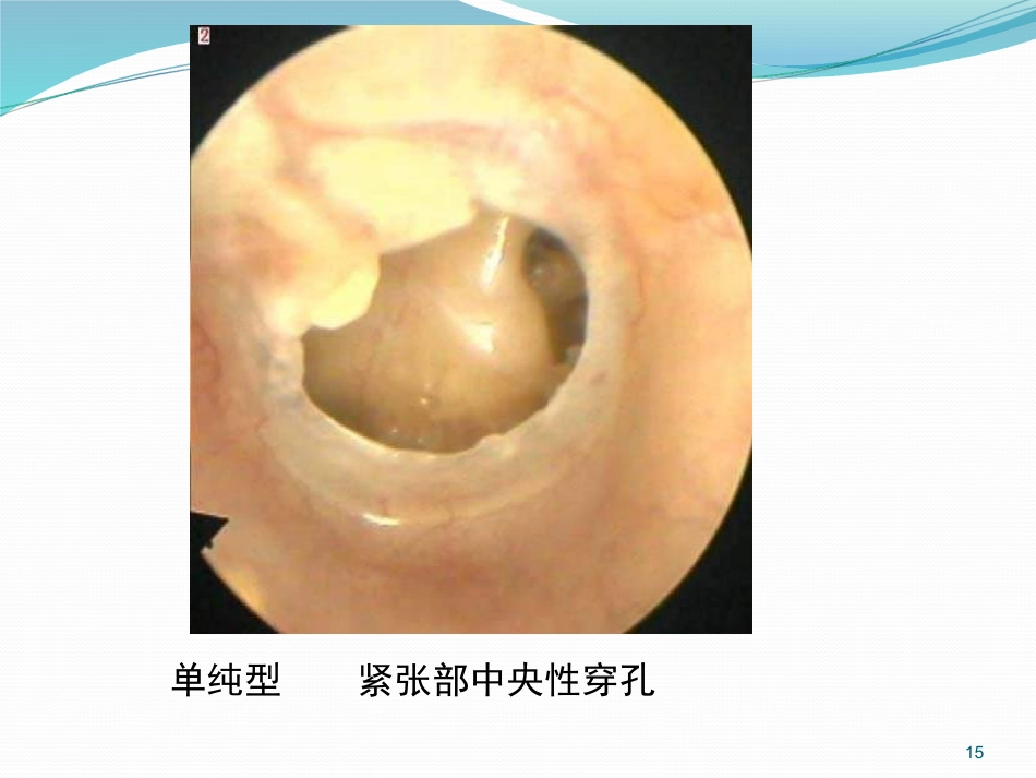 耳鼻喉的解剖及常见病PPT幻灯片_第15页