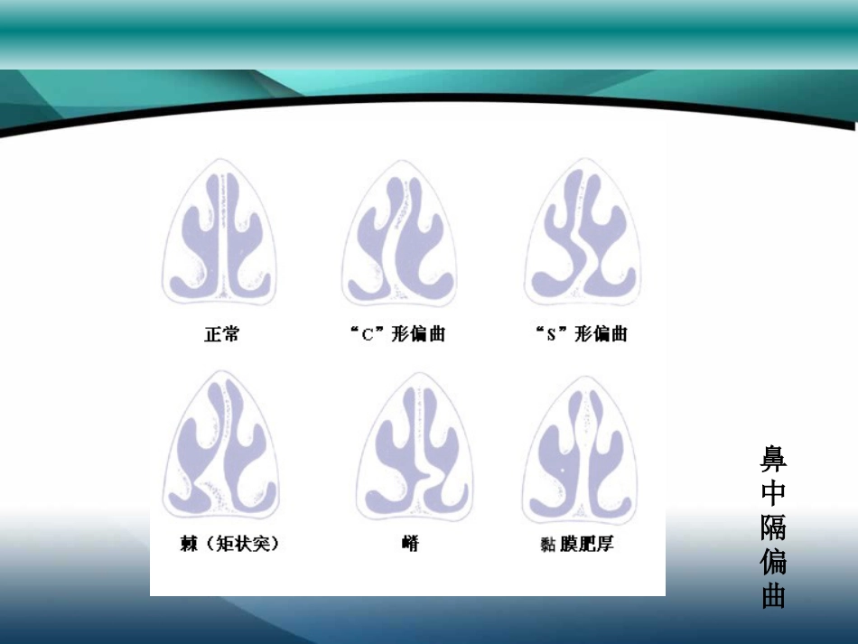 鼻中隔疾病_第7页