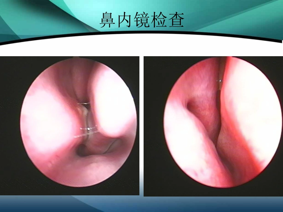 鼻中隔疾病_第8页
