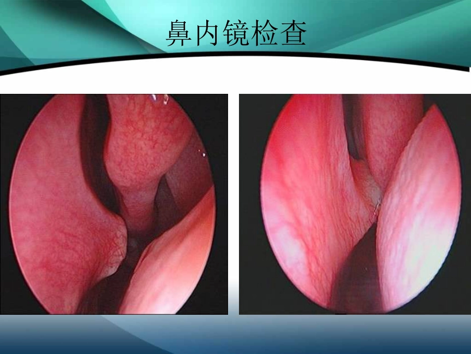 鼻中隔疾病_第9页