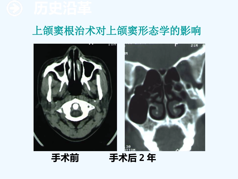 鼻内窥镜技术_第4页