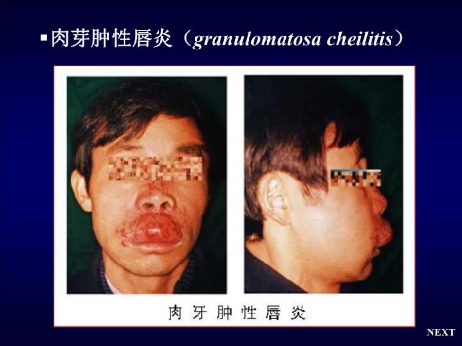 唇舌疾病 PPT课件_第11页