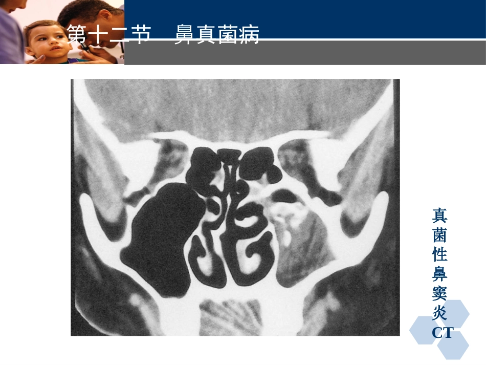 耳鼻喉科常见疾病-真菌性鼻窦炎_第8页