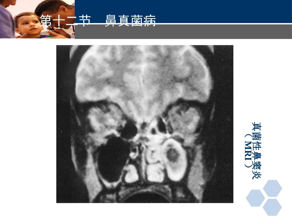 耳鼻喉科常见疾病-真菌性鼻窦炎_第9页