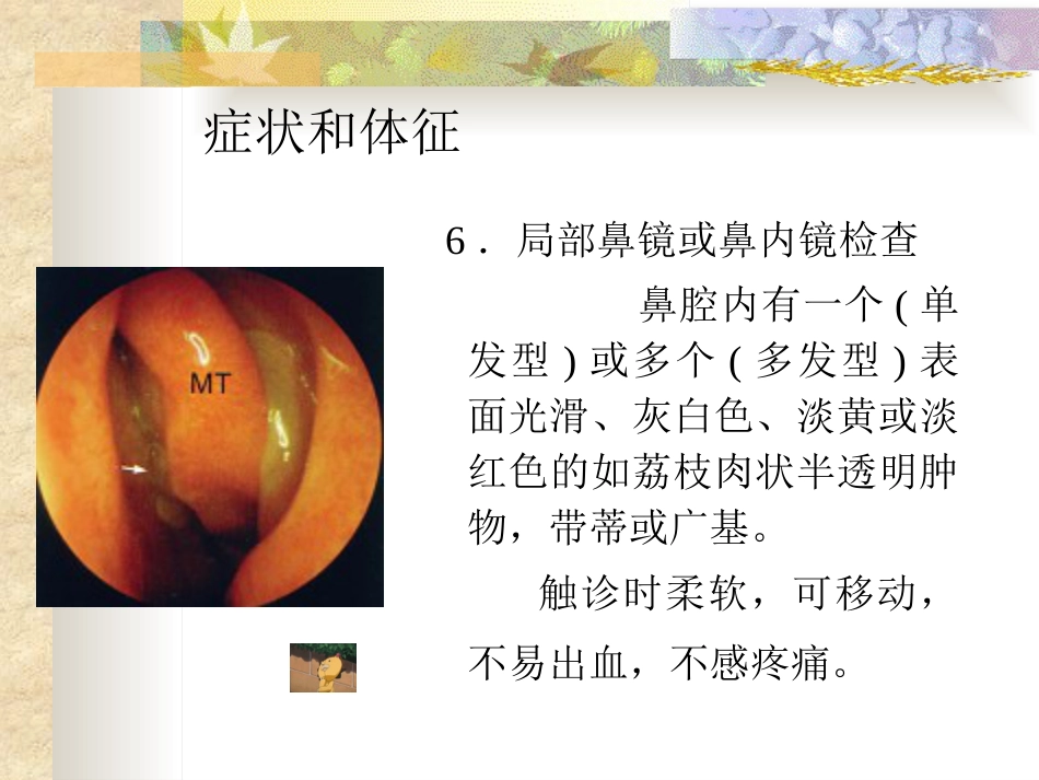 鼻息肉(nasal polyp)_第15页