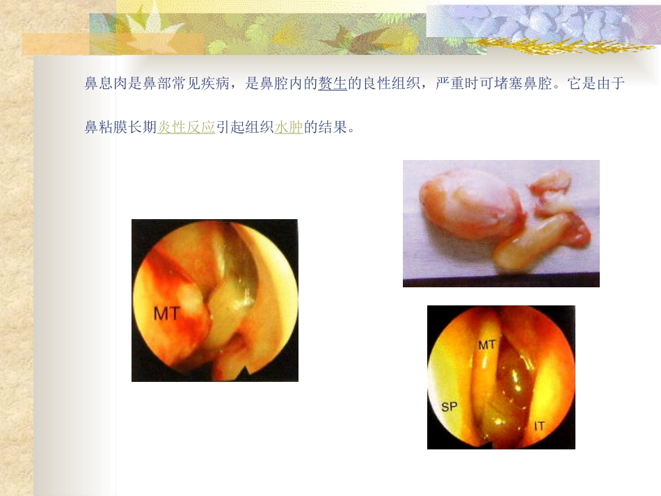 鼻息肉(nasal polyp)_第3页