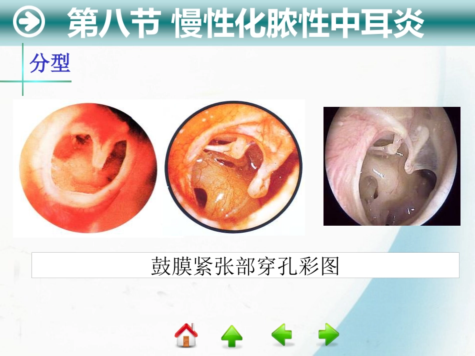 耳部疾病_第12页