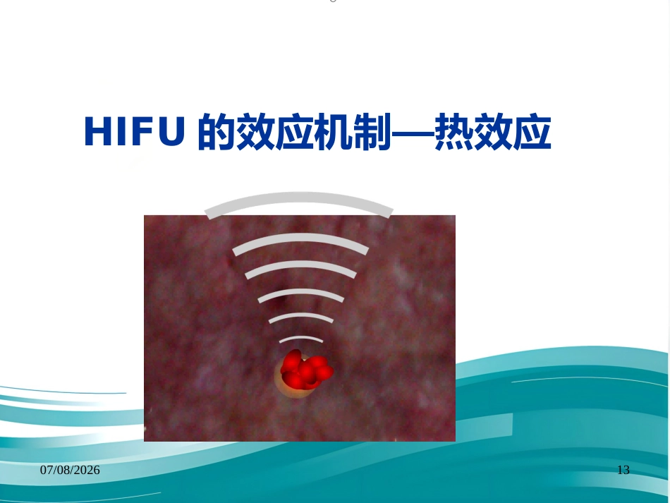 聚焦超声技术在变应性鼻炎治疗中的应用--Harbin_第13页