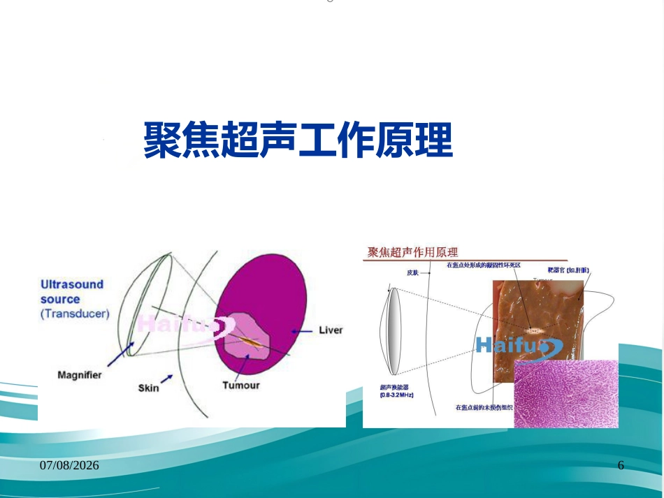 聚焦超声技术在变应性鼻炎治疗中的应用--Harbin_第6页
