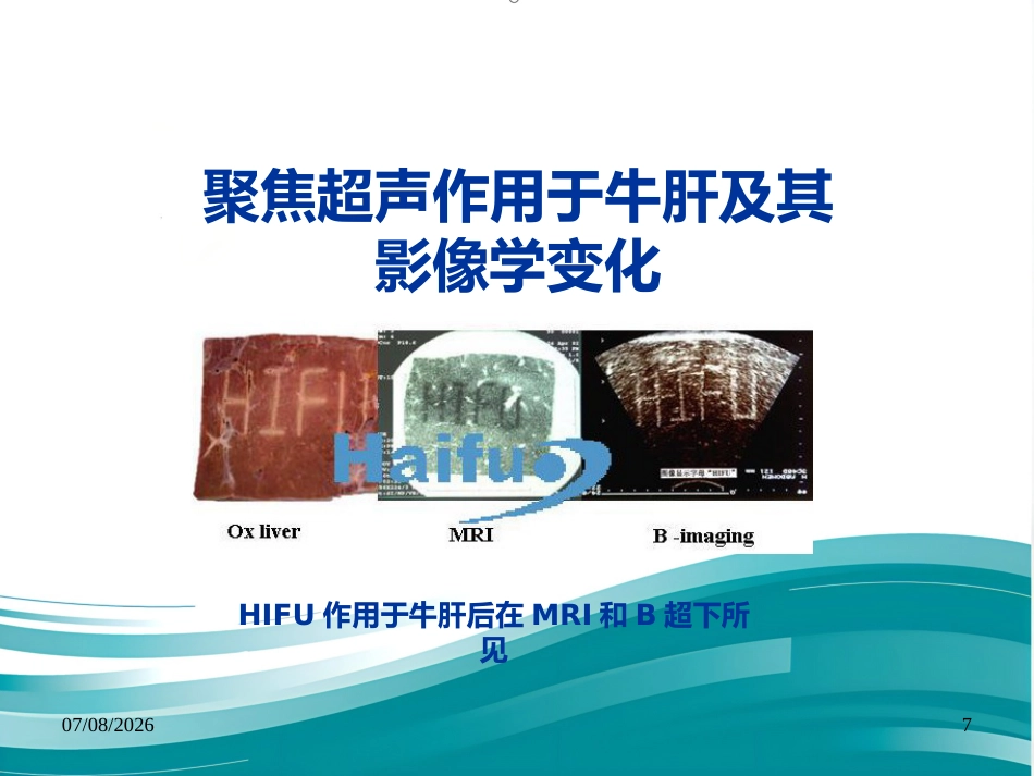 聚焦超声技术在变应性鼻炎治疗中的应用--Harbin_第7页