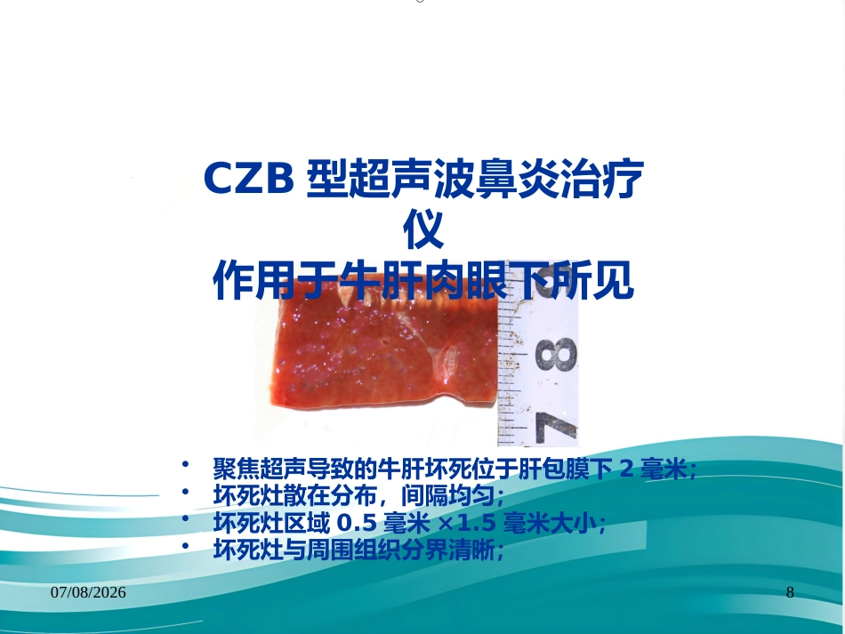 聚焦超声技术在变应性鼻炎治疗中的应用--Harbin_第8页