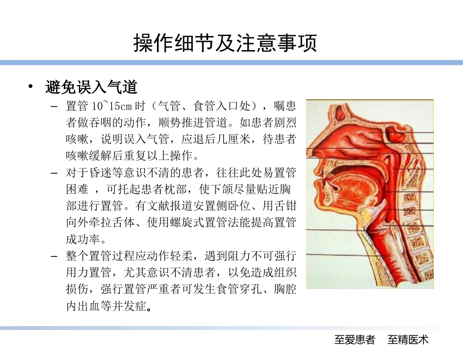 床旁盲插鼻肠管的技巧_第10页