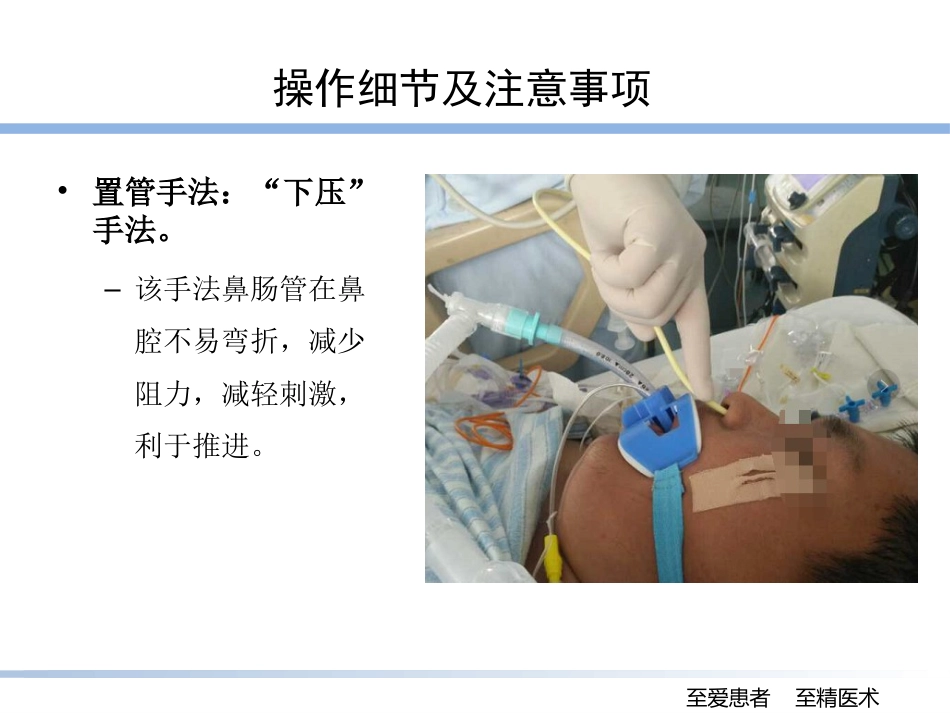 床旁盲插鼻肠管的技巧_第11页