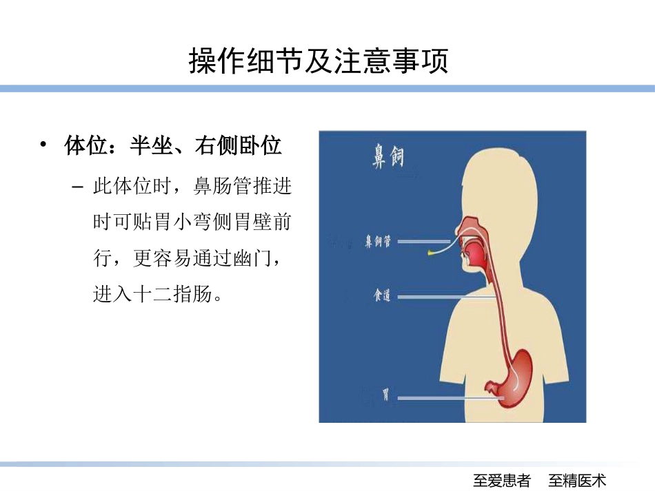 床旁盲插鼻肠管的技巧_第8页