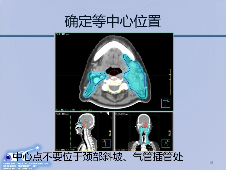 鼻咽癌放射治疗计划设计PPT课件_第15页
