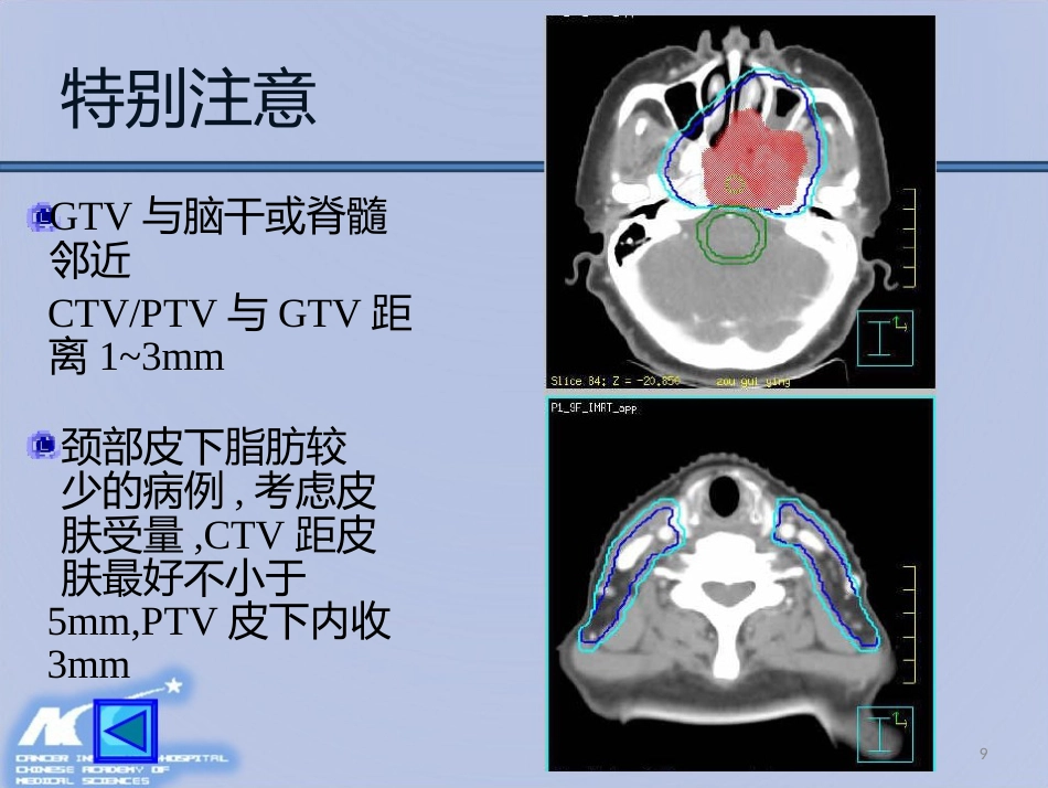 鼻咽癌放射治疗计划设计PPT课件_第9页