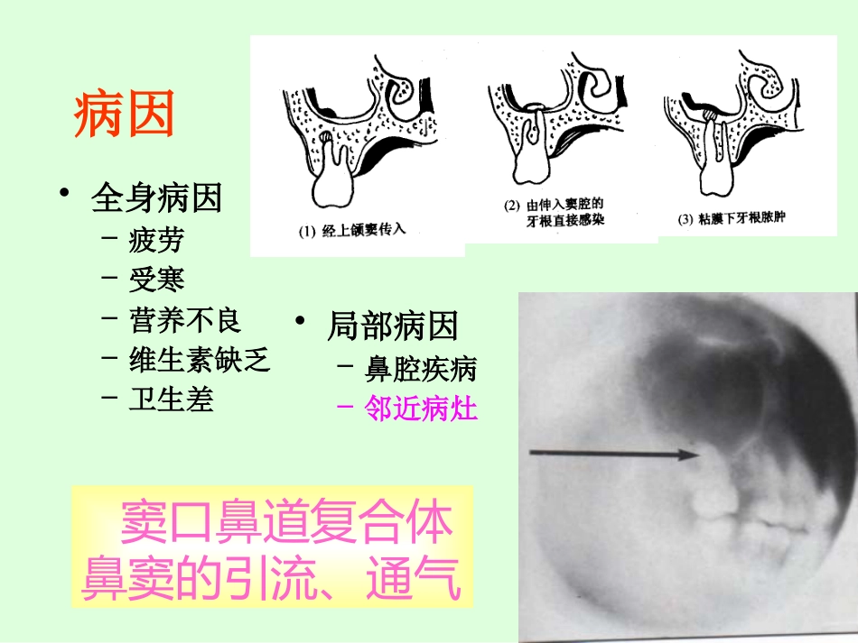 sinusitisacute 急性鼻窦炎_第10页