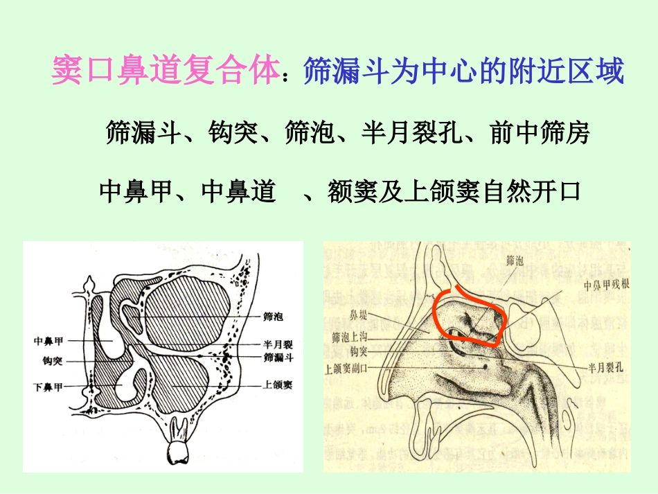 sinusitisacute 急性鼻窦炎_第5页