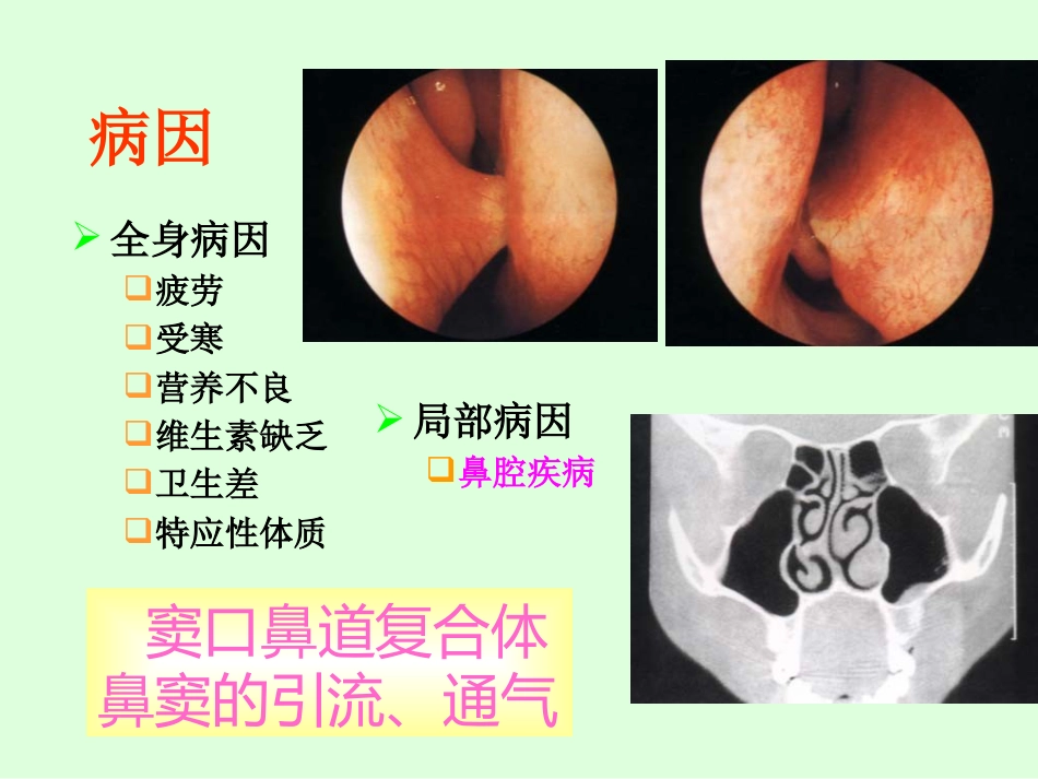 sinusitisacute 急性鼻窦炎_第8页