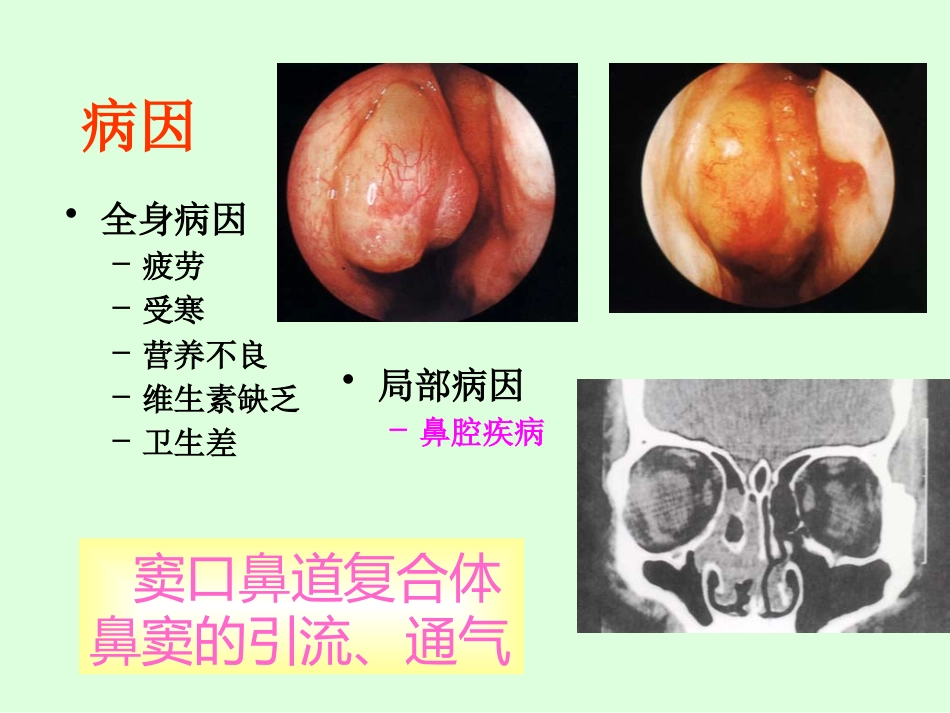 sinusitisacute 急性鼻窦炎_第9页