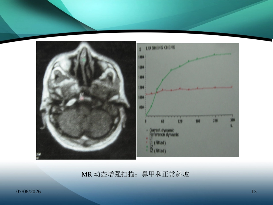 复发鼻咽癌的诊治_第13页
