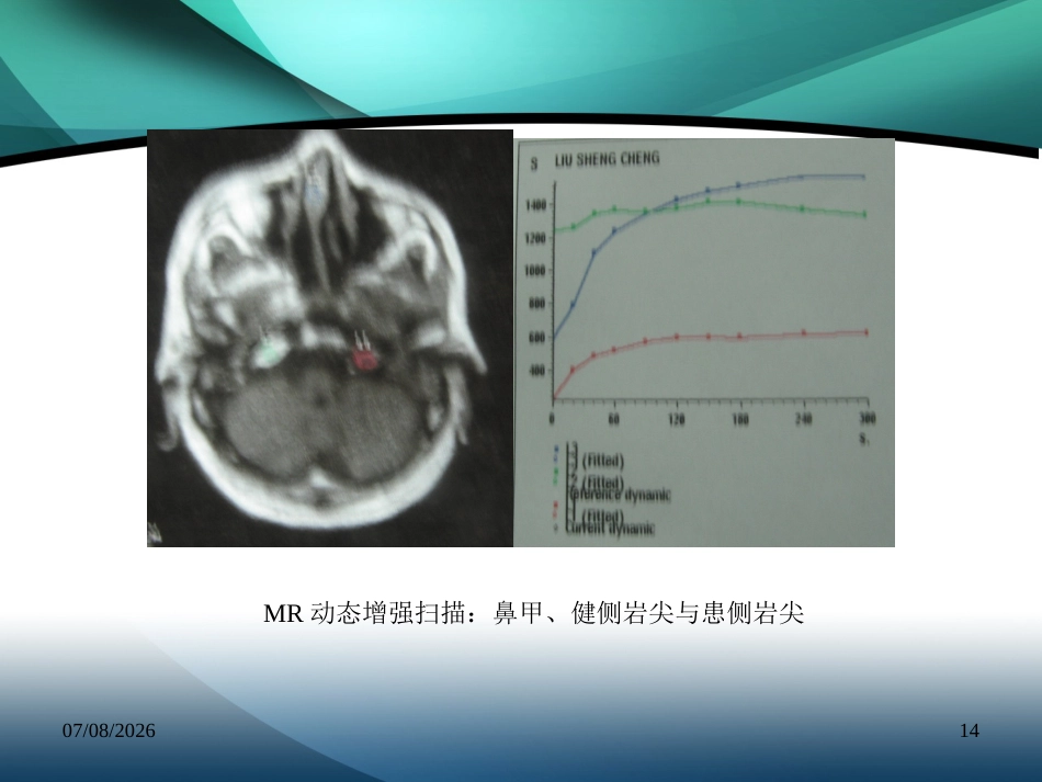 复发鼻咽癌的诊治_第14页