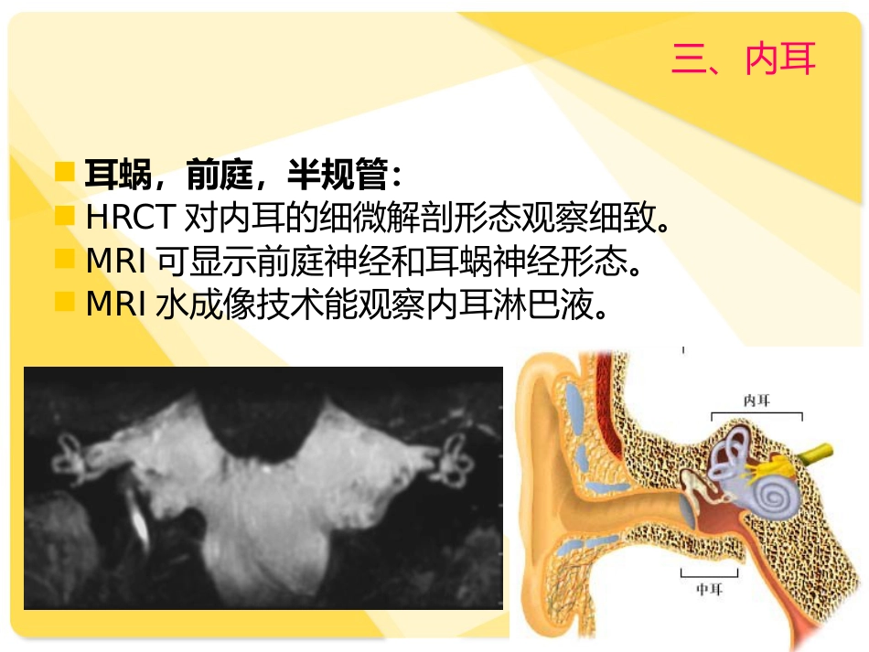 耳部解剖及常见疾病诊断_第14页