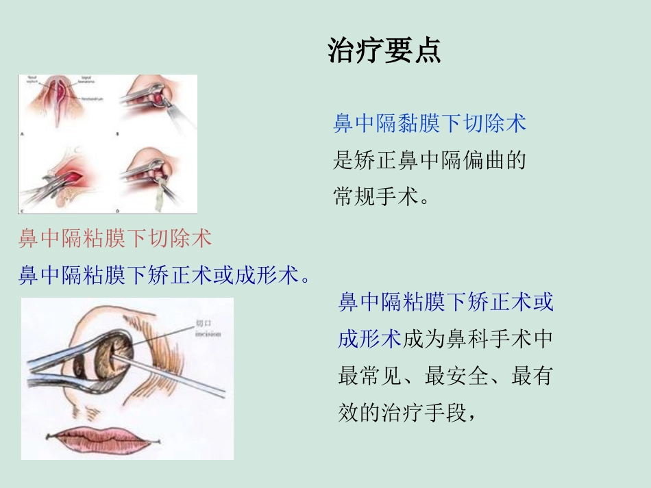 (推荐)鼻中隔偏曲矫正术张影_第14页