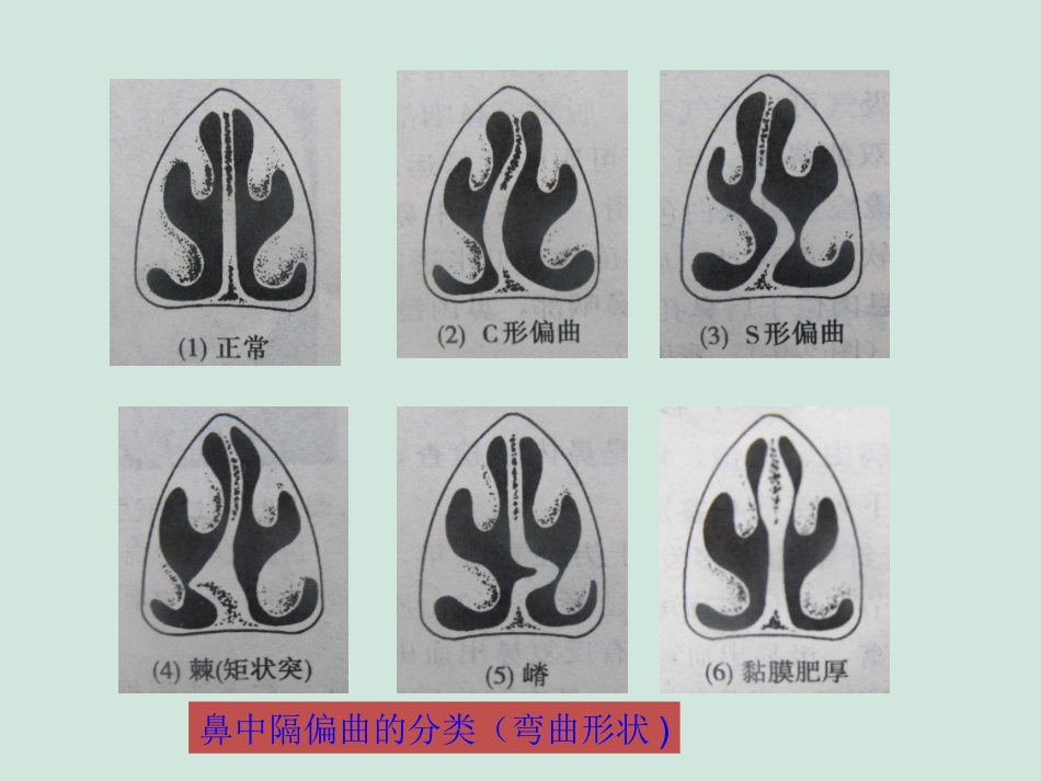 (推荐)鼻中隔偏曲矫正术张影_第7页