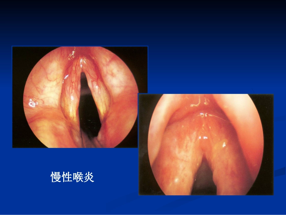 间接喉镜检查_第10页