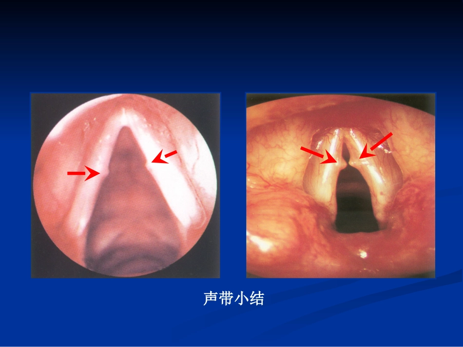 间接喉镜检查_第13页